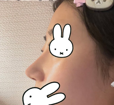[강남성형외과 복코성형 후기] 두꺼운 피부라 얄쌍해지기 어렵다던 제 복코.. 지금은 콧볼까지 얇아졌어요 관련 이미지 6