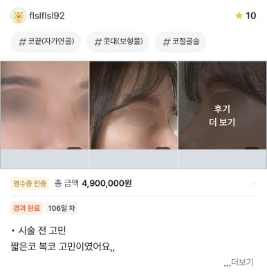 [Gangnam Station Plastic Surgery Clinic Bulbous Nose Rhinoplasty Review] My nose used to spread when I smiled and caused me stress... Now I’ve found the nose of my dreams! Haha image 1