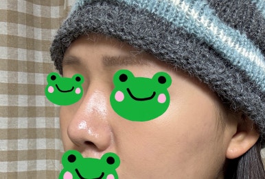 [Gangnam Plastic Surgery Rhinoplasty Review] My Short Nose Looked Upturned from the Front… Now It Has the Perfect Line with Postoperative Care Too! image 7