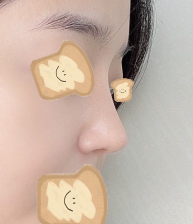 [Gangnam Station Plastic Surgery Nose Revision Review] A Tearful 4th Revision Marked by Failure... I Met Dr. Kim Jun-hyung and Succeeded! image 6
