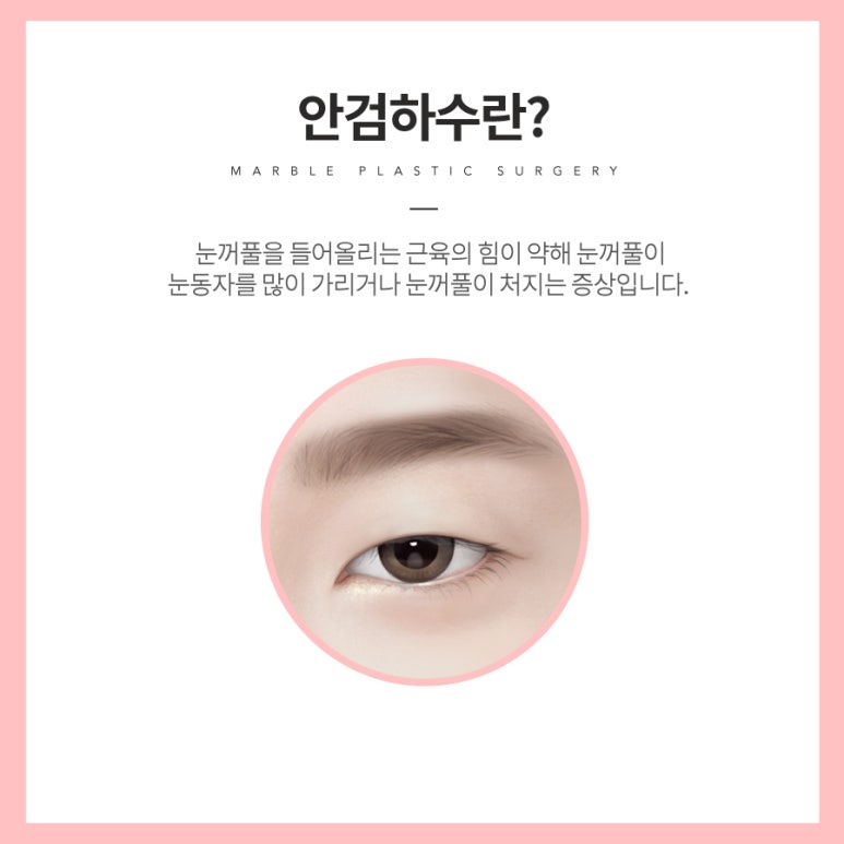 안검하수수술비용 부담되시나요? 관련 이미지 2