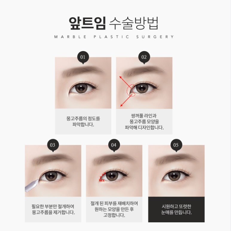 앞트임흉살 걱정되시나요? 마블성형외과의원 관련 이미지 4