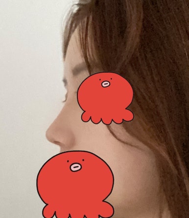 [강남성형외과 매부리코성형 후기] 부작용만 찾다가,, 금손 원장님 만나 코 정착했어요! 관련 이미지 6