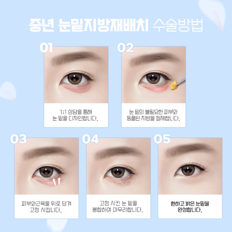 중년눈성형 더 예리하고 젊게 관련 이미지 6