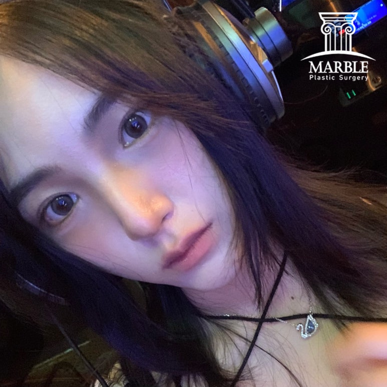 눈매교정 해야 하는 눈일까? 마블성형외과의원에서 알아보자! 관련 이미지 5