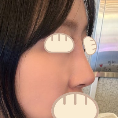 [강남성형외과 복코성형 후기] 보정하기 바빴던 펑퍼짐한 복코.. 얼굴 밸런스에 맞게 바꿔주셨어요! 관련 이미지 5