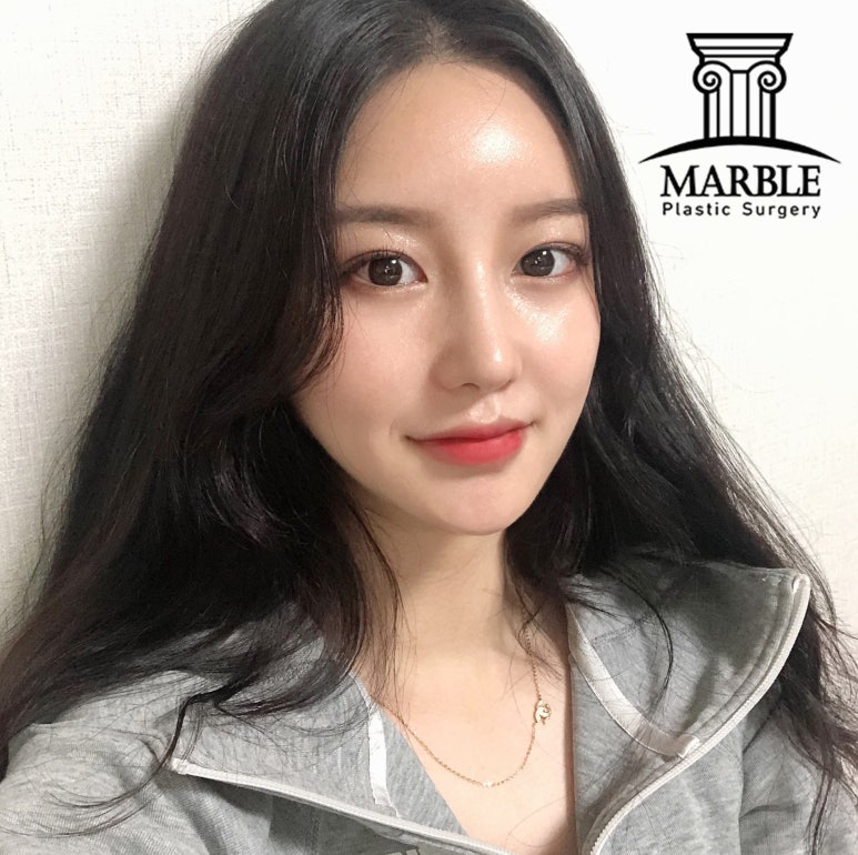 강남역성형외과, 쌍꺼풀후기 첫 눈에 반하는 눈! 관련 이미지 4