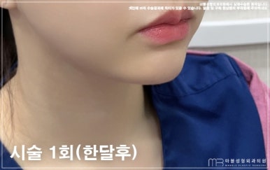Marvel Plastic Surgery Clinic V-Up Injection Contouring Injection Review and Experience (Before-and-After Photos O) image 7