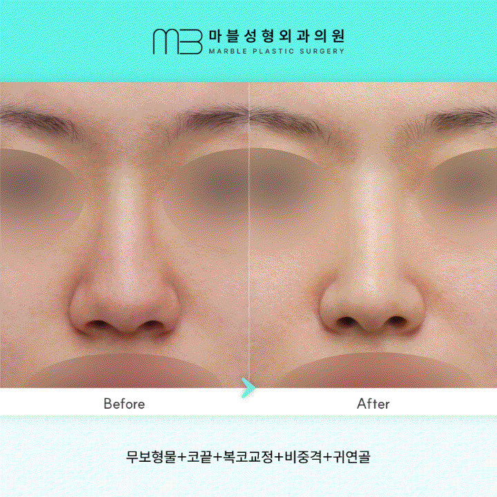 [무보형물 코성형] 복코교정 3개월 차: 비중격+귀연골 활용의 정석 관련 이미지 1