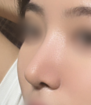 [마블성형외과 코성형 후기] 코수술 한 티도 안 나던 뭉툭한 복코... 재수술로 드디어 정착했어요ㅠㅠ 관련 이미지 6