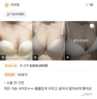 [Gangnam Station Plastic Surgery Clinic Breast Surgery Review] I was determined to go as large as possible... but a detailed rib cage analysis helped me find the perfect proportions! image 1