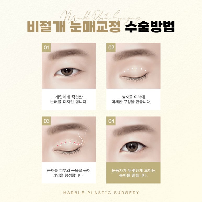 눈매교정부작용 벗어날 방법 알아보기 관련 이미지 8