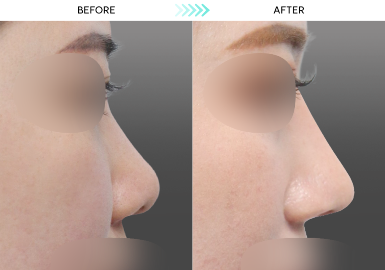 [Revision Rhinoplasty] 5 Months After Short Nose Correction: The Standard Approach to Bulbous Nose Correction and Alar Reduction image 5