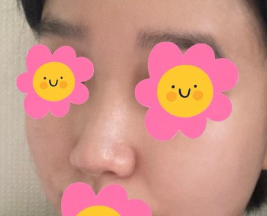 [Marble Plastic Surgery Nose Surgery Review] I Kept Worrying About My Hump Nose... I Should Have Had Surgery Sooner image 3