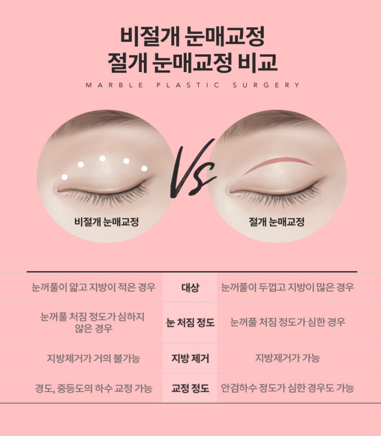안검하수수술비용 부담되시나요? 관련 이미지 5