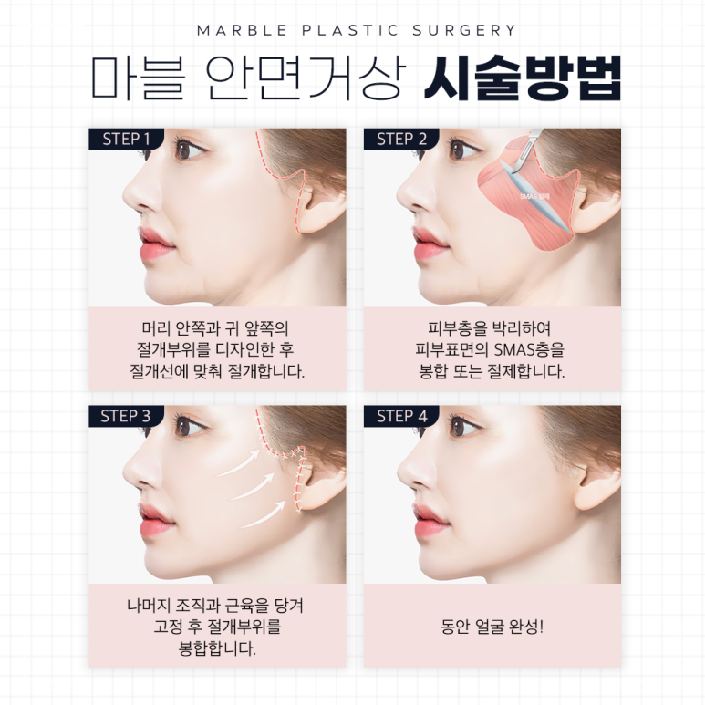 안면거상술 유지기간 + 효과, 오래 유지하고 싶다면?｜마블성형외과 관련 이미지 4