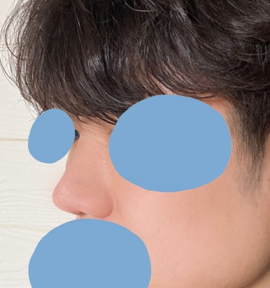 [Gangnam Plastic Surgery Male Nose Surgery Review] After tidying up the hump and bulbous nose that made me look stuffy, my T-zone and facial features looked completely alive! image 6