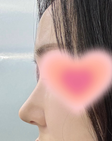 [강남역 성형외과 코수술 후기] 김준형 원장님 덕분에무보형물로 코끝교정 성공! 예쁜 직반 라인 얻었어요ㅎㅎ 관련 이미지 7