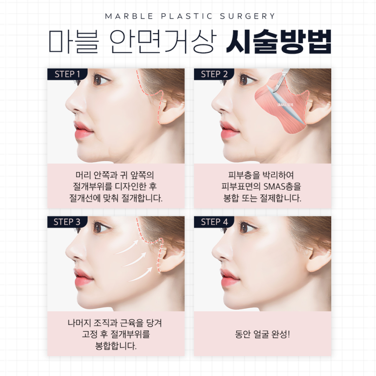 안면거상술효과 처진 얼굴 고민, 추천대상은?｜마블성형외과 관련 이미지 4