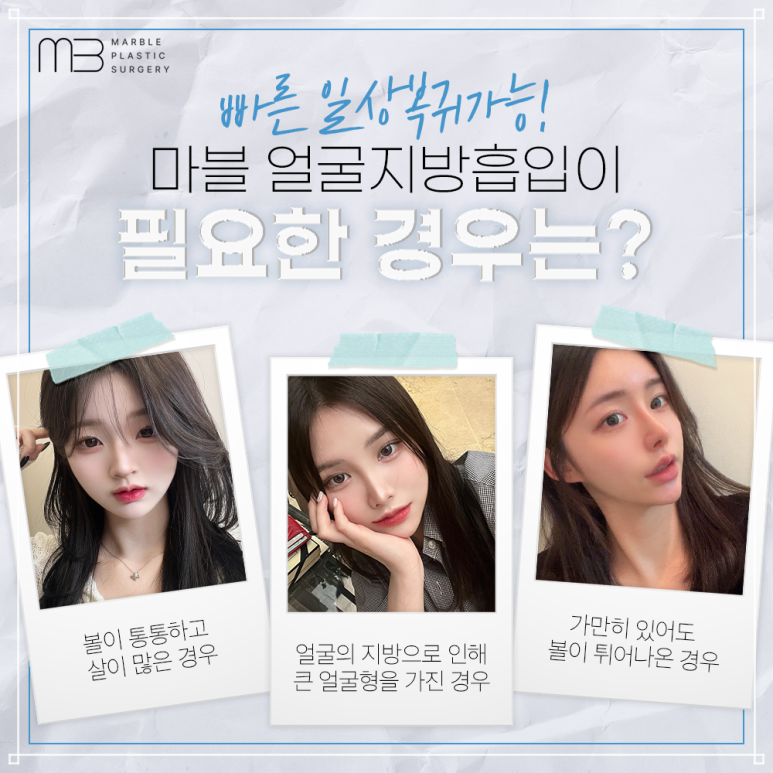 Worried About Swelling After Facial Liposuction? Here’s a Summary of Who It’s For and Recovery Tips! | Marble Plastic Surgery image 3