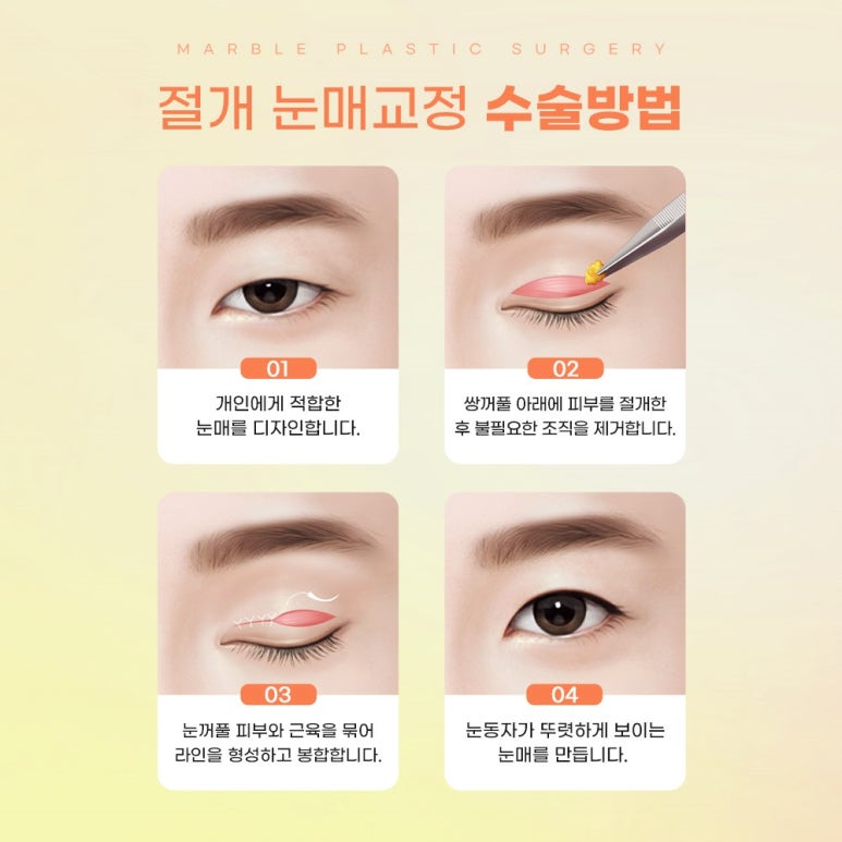 남자눈매교정가격, 잘 알아보고 결정 관련 이미지 6