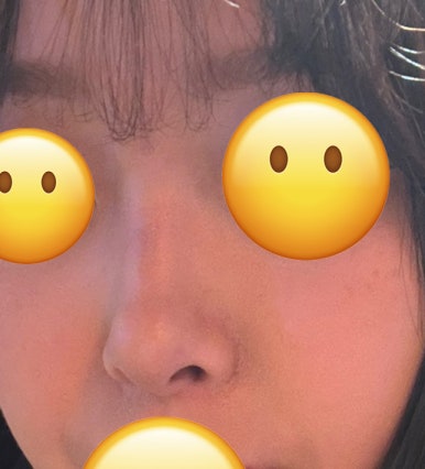 [Bulbous Nose Surgery Review] Solved My Plain Bulbous Nose Concerns! I Got a More Defined Nasal Bridge and a Better Impression! image 3