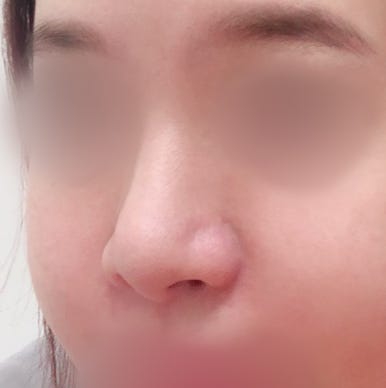 [강남역성형외과 매부리코성형 후기] 첫 수술 실패한 복코 매부리코.. 재수술로 완벽하게 성공했어요! 관련 이미지 3