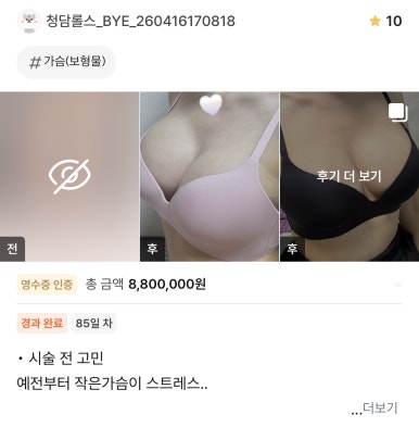 [강남역 성형외과 가슴수술 후기] 지방이식으로도 불만족이었는데,, 서일범 원장님표 라인으로 인생 핏 성공! 관련 이미지 1