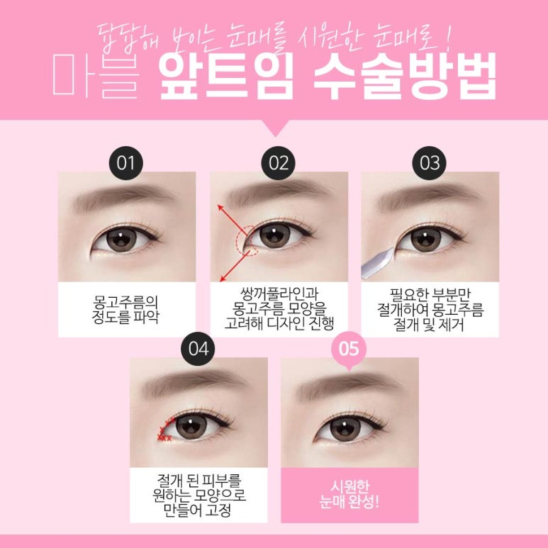앞트임전후 확실히 비교해보고 결정하자 마블성형외과의원 관련 이미지 4