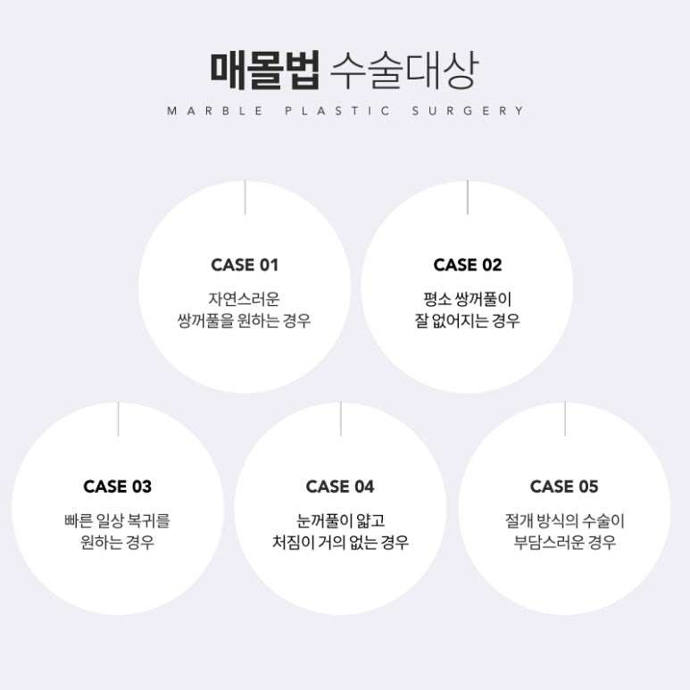 쌍수매몰법 섬세한 디테일로 자연스럽게! 관련 이미지 4