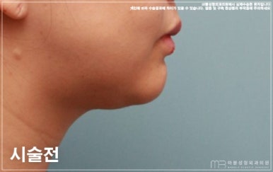 Marvel Plastic Surgery Clinic V-Up Injection Contouring Injection Review and Experience (Before-and-After Photos O) image 6