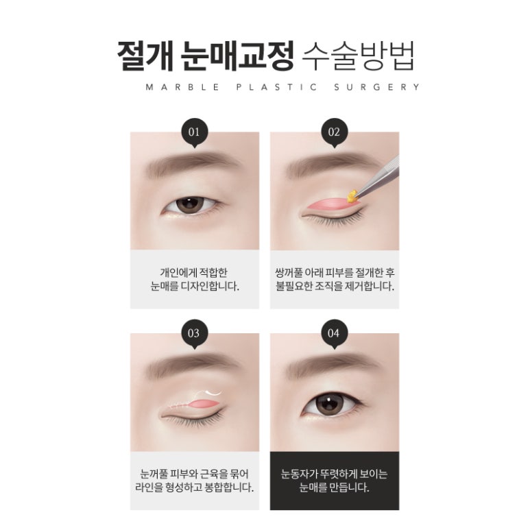 눈매교정 부작용 무엇이 있을까? 관련 이미지 7