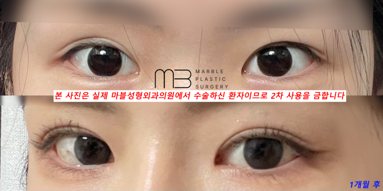 눈재수술 잘 알아봐야 관련 이미지 2
