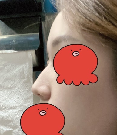 [강남성형외과 매부리코성형 후기] 부작용만 찾다가,, 금손 원장님 만나 코 정착했어요! 관련 이미지 4