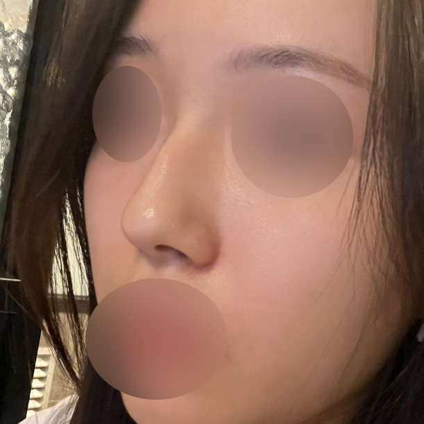 Hump Nose Surgery Is Not Simply a Procedure to Shave It Down. image 2