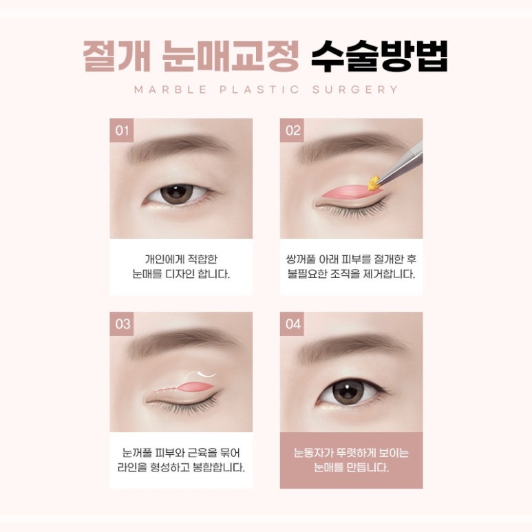 눈성형잘하는곳의 수술과 눈매교정에 대하여 관련 이미지 4