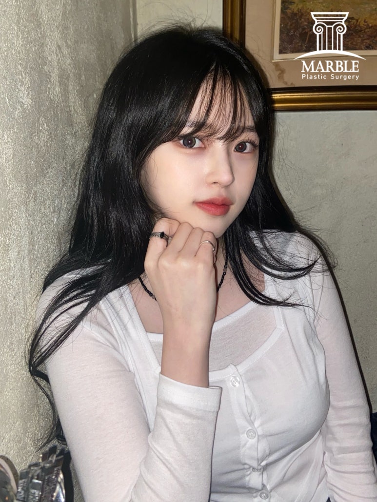 더 이상 쌍꺼풀재수술은 그만, 내 눈은 왜 잘 풀릴까? 관련 이미지 1