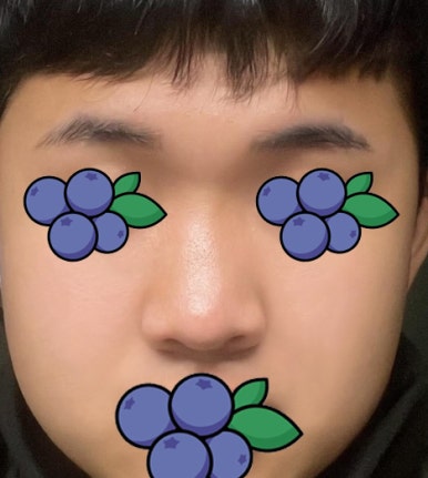 [강남성형외과 매부리코수술 후기] 울퉁불퉁한 옆 라인 고민.. 자가늑 덕분에 또렷한 콧대로 변신했어요! 관련 이미지 4