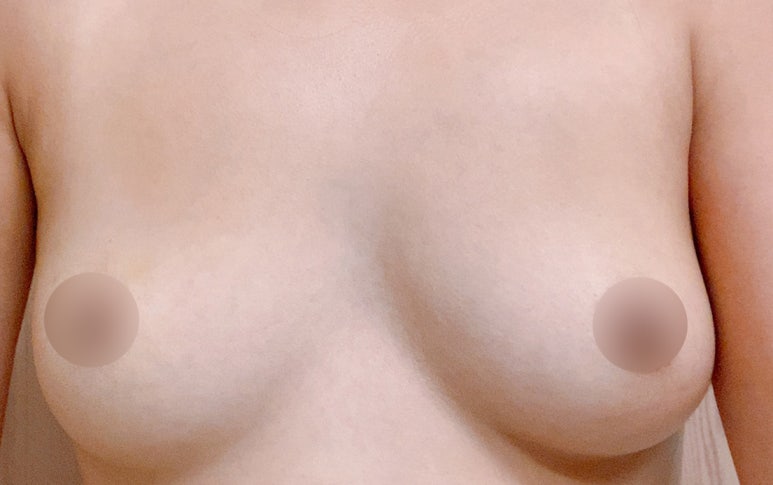 How Long It Took to Return to Daily Life After Breast Augmentation: A Real Review image 4