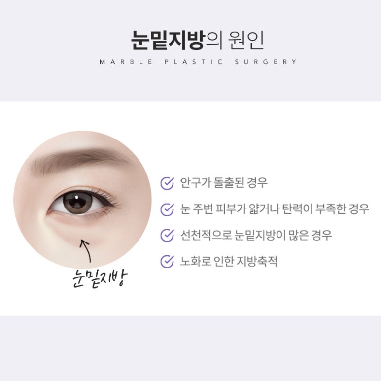 눈밑지방재배치 칙칙한 인상은 그만! 관련 이미지 6