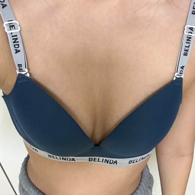 [강남성형외과 가슴확대수술 후기] 벌어진 작은 가슴이 늘 고민이었는데..자연스러운 I자 가슴골로 대만족! 관련 이미지 1
