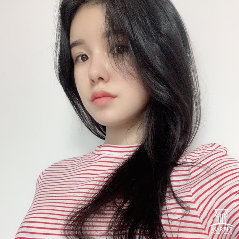 눈재수술비용 알아보고 있다면 관련 이미지 3