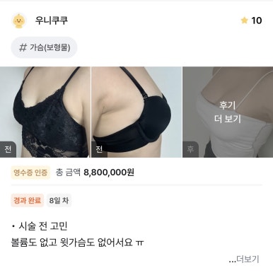 [강남성형외과 가슴확대수술 리얼후기] 운동으로 안되던 윗가슴 빈약함 해결! 꽉 찬 볼륨 완성이에요ㅎㅎ 관련 이미지 1