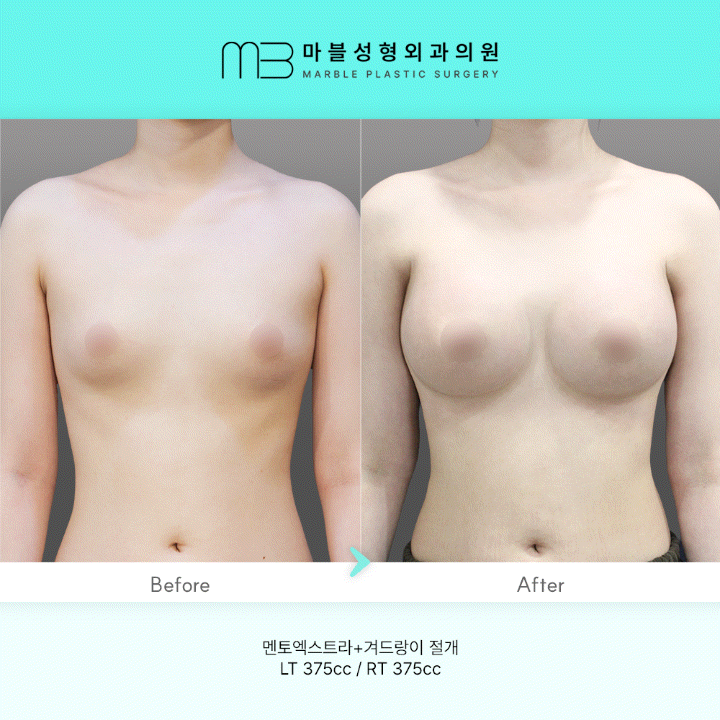 [멘토 가슴성형] 가슴확대수술 3개월 차: 멘토엑스트라로 완성한 라인의 정석 관련 이미지 1