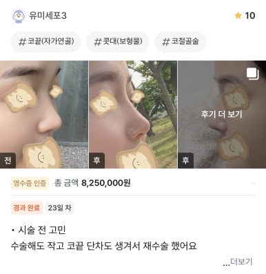 [Gangnam Station Plastic Surgery Nose Revision Review] A Tearful 4th Revision Marked by Failure... I Met Dr. Kim Jun-hyung and Succeeded! image 1