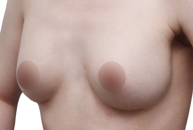 가슴재수술, 실패를 줄이기 위한 기준은? 관련 이미지 1