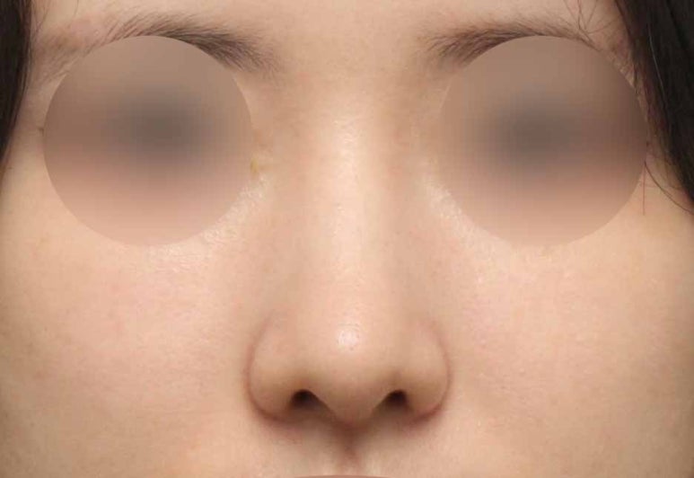 매부리코수술 전후 공개, 과하지 않게 교정한 리얼 경험 관련 이미지 4