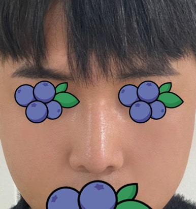 [강남성형외과 매부리코수술 후기] 울퉁불퉁한 옆 라인 고민.. 자가늑 덕분에 또렷한 콧대로 변신했어요! 관련 이미지 7