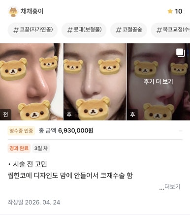 [강남역성형외과 매부리코수술 후기] 코재수술이라 진짜 무서웠는데 매부리코, 복코교정 한번에 해결 됐어요! 관련 이미지 1