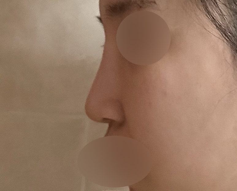 서초구 코수술 잘하는곳 마블성형외과에서 예쁜 코라인으로 변화 관련 이미지 2